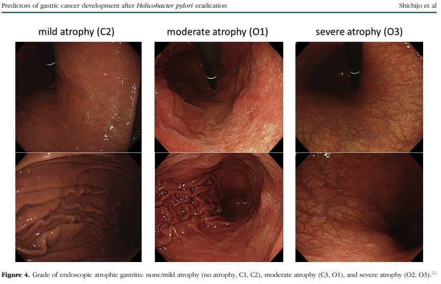 Histologic intestinal metaplasia and endoscopic atrophy are predictors of gastric cancer development af.jpg